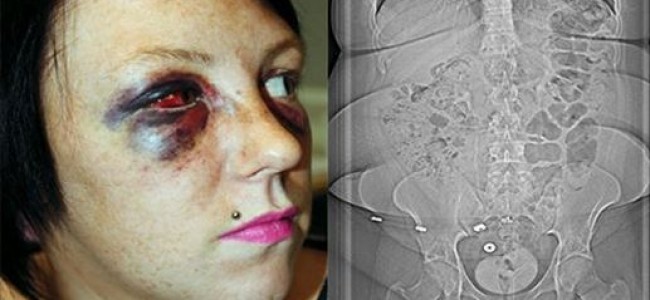 Ljubomorni momak promijenio lični opis bivšoj djevojci i slomio joj kičmu